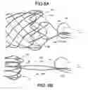 Fig. 04 - INTEGRATED STENT RETRIEVAL LOOP ADAPTED FOR SNARE REMOVAL AND/OR OPTIMIZED PURSE STRINGING