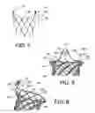 Fig. 05 - INTEGRATED STENT RETRIEVAL LOOP ADAPTED FOR SNARE REMOVAL AND/OR OPTIMIZED PURSE STRINGING