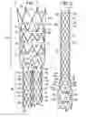Fig. 02 - STENT - GRAFT SUTURE LOCKS
