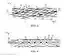 Fig. 03 - Helical stent with connections