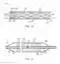 Fig. 06 - Stent with constant stiffness along the length of the stent