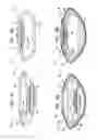 Fig. 05 - ACCOMMODATIVE INTRAOCULAR LENS
