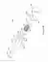 Fig. 15 - Composite implant