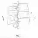 Fig. 02 - Method and device for treatment of the spine