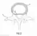 Fig. 03 - Method and device for treatment of the spine