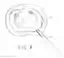 Fig. 04 - Method and device for treatment of the spine