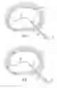 Fig. 07 - Method and device for treatment of the spine