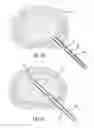 Fig. 12 - Method and device for treatment of the spine