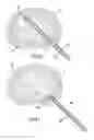 Fig. 13 - Method and device for treatment of the spine