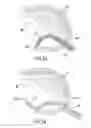 Fig. 21 - Method and device for treatment of the spine