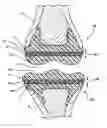 Fig. 01 - End surface mounted plugs incorporated into an artificial joint and including cushioned soft plastic between outer hardened plastic layers