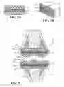 Fig. 03 - End surface mounted plugs incorporated into an artificial joint and including cushioned soft plastic between outer hardened plastic layers