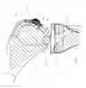 Fig. 06 - Articular surface implant and delivery system