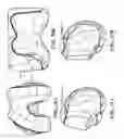 Fig. 18 - Patient-adapted and improved articular implants, designs and related guide tools