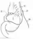 Fig. 01 - Tissue interface for implantable restriction system