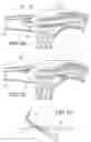 Fig. 32 - Tissue interface for implantable restriction system
