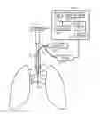 Fig. 01 - Multiple channel tracheal tube placement device and technique for using the same