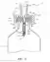 Fig. 06 - Vial adaptors and vials for regulating pressure