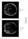 Fig. 13 - Non-contrast MRA using region-selective saturation pulse followed by non-region selective inversion recovery pulse to larger overlapped area