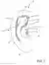 Fig. 02 - Soft Concha Ring In-The-Ear Hearing Aid