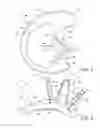 Fig. 03 - Soft Concha Ring In-The-Ear Hearing Aid
