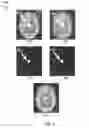 Fig. 06 - Accurate determination of the shape and localization of metallic object(s) in X-ray CT imaging