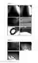 Fig. 05 - TEMPORARY EMBOLIZATION USING INVERSE THERMOSENSITIVE POLYMERS