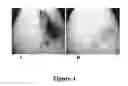 Fig. 02 - METHODS OF INCREASING NEURONAL DIFFERENTIATION USING ANTIBODIES TO LYSOPHOSPHATIDIC ACID