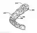 Fig. 01 - Activatable dental appliance