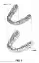 Fig. 02 - Activatable dental appliance