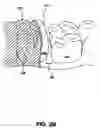 Fig. 04 - Activatable dental appliance