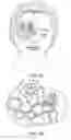 Fig. 03 - EYE PATCH KIT AND METHODS OF PROMOTING USE COMPLIANCE