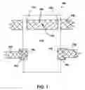Fig. 02 - PROLAPSE REPAIR DEVICE AND METHODS OF USE