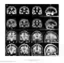Fig. 02 - Automatic MRI Quantification of Structural Body Abnormalities