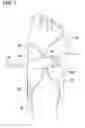 Fig. 02 - Pneumatic compression garment with noise attenuating means