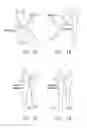 Fig. 02 - METHOD AND APPARATUS FOR MANAGING JOINT IRRIGATION DURING HIP ARTHROSCOPY