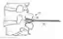 Fig. 01 - Vertebral Body Spool Device