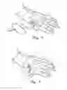 Fig. 03 - Methods and devices for treating a structural bone and joint deformity