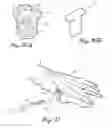 Fig. 08 - Methods and devices for treating a structural bone and joint deformity