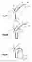 Fig. 12 - Suture based tissue repair