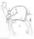 Fig. 06 - Devices For Installing Stasis Reducing Means In Body Tissue
