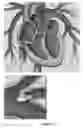 Fig. 04 - LARGE MOUTH SNARE DEVICE