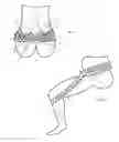 Fig. 03 - Pelvic and lumbar spine support