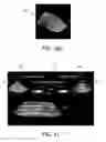 Fig. 08 - Extended field of view ultrasonic imaging with a two dimensional array probe