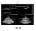 Fig. 09 - Extended field of view ultrasonic imaging with a two dimensional array probe