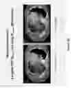 Fig. 14 - Method and system for four dimensional intensity modulated radiation therapy for motion compensated treatments