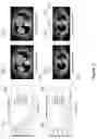 Fig. 18 - Method and system for four dimensional intensity modulated radiation therapy for motion compensated treatments