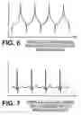 Fig. 06 - Analyzing ECG data in deciding on patient chest compression treatment