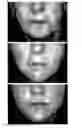 Fig. 01 - METHODS FOR MEASURING CHANGE IN LIP SIZE AFTER AUGMENTATION