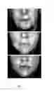 Fig. 02 - METHODS FOR MEASURING CHANGE IN LIP SIZE AFTER AUGMENTATION